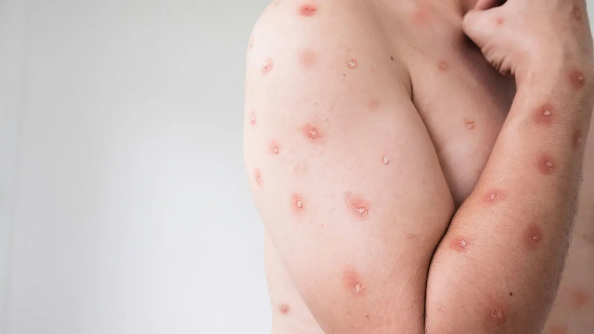 Porto Alegre confirma primeiro caso de mpox em 2026 e acende alerta para o Carnaval Porto Alegre confirma primeiro caso de mpox em 2026 e acende alerta para o Carnaval