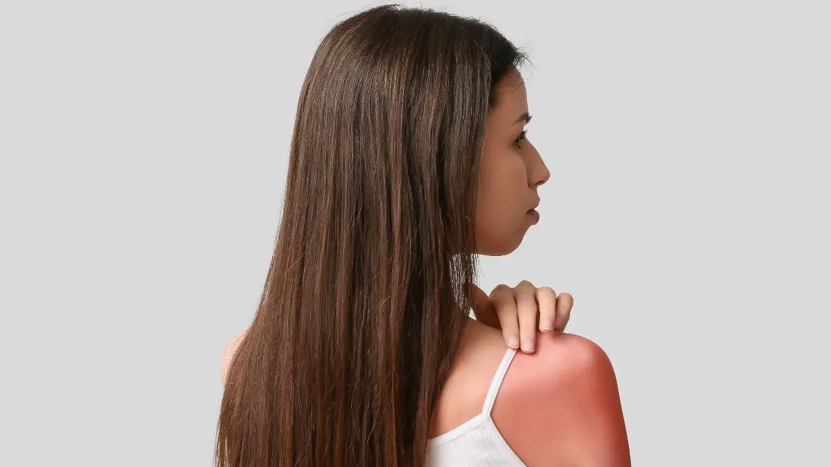 Uso incorreto da babosa em queimaduras de sol oferece riscos de irritação grave Uso incorreto da babosa em queimaduras de sol oferece riscos de irritação grave