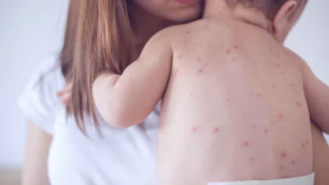 Sarampo acende alerta no Brasil com cidades abaixo de 10% de cobertura e segunda dose chegando a apenas 1%