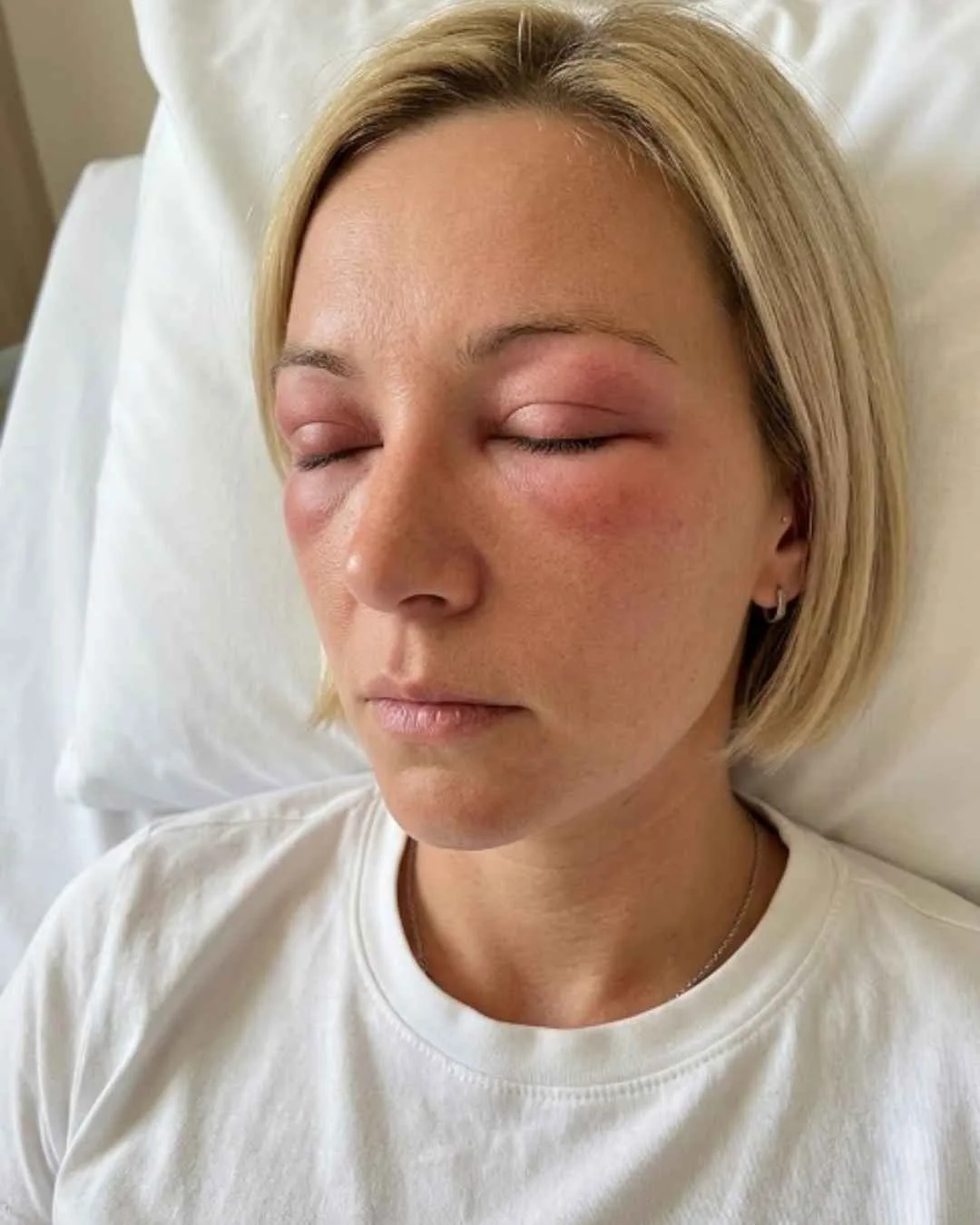 Mulher deitada com os olhos inchados após reação a extensão de cílios